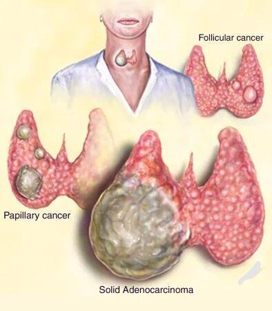 甲状腺癌不切除治疗