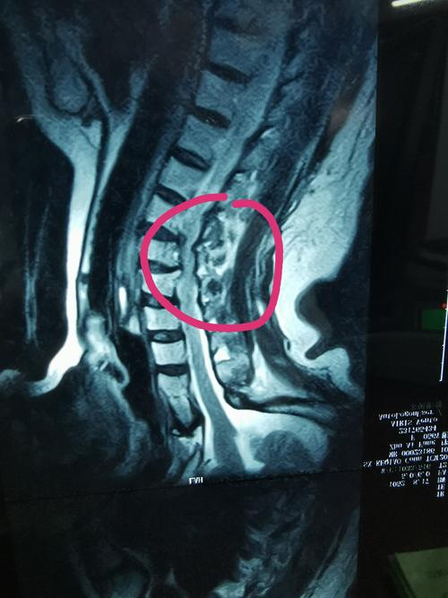 颈椎间盘突出但无椎管狭窄