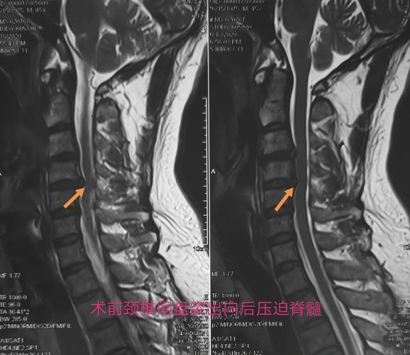 颈椎间盘突出但无椎管狭窄