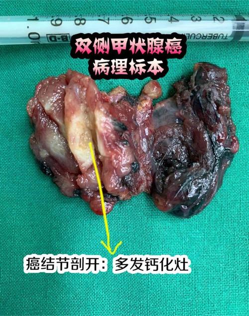 甲状腺癌斑点状钙化