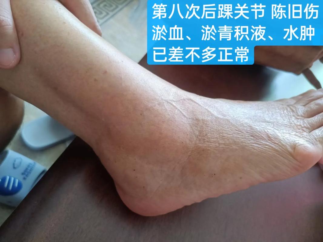 老人中风后手脚肿如何消肿