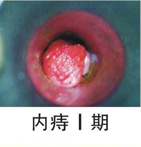 大便不成形痔疮复发怎么办