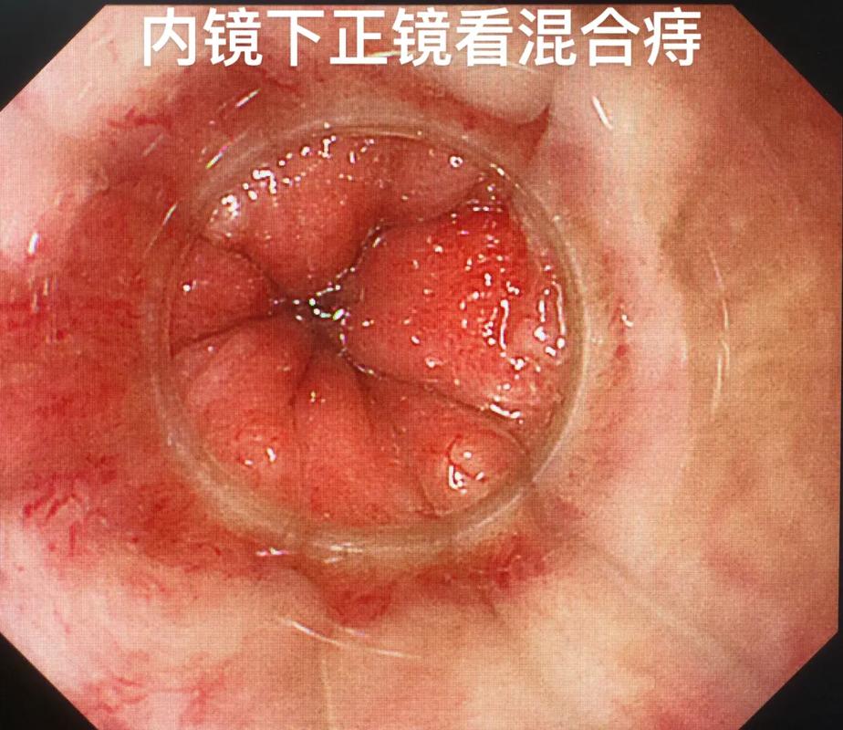 传统痔疮手术之后要拆线嘛