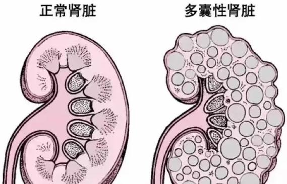 动物多囊肾病的症状表现