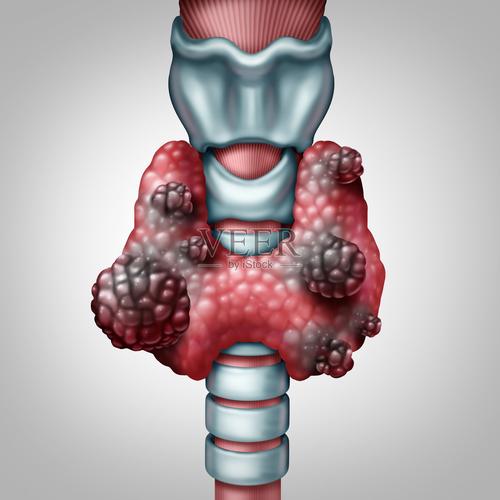 甲状腺癌存活多少年