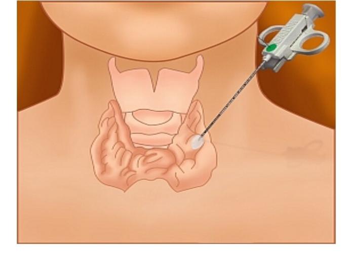 甲状腺癌穿刺怎么做