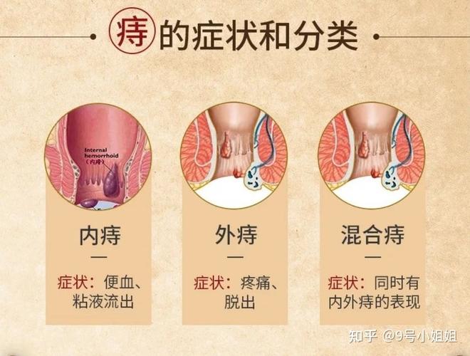 大便不成形痔疮复发怎么办