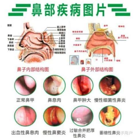 鼻炎咽炎会不会变鼻咽癌