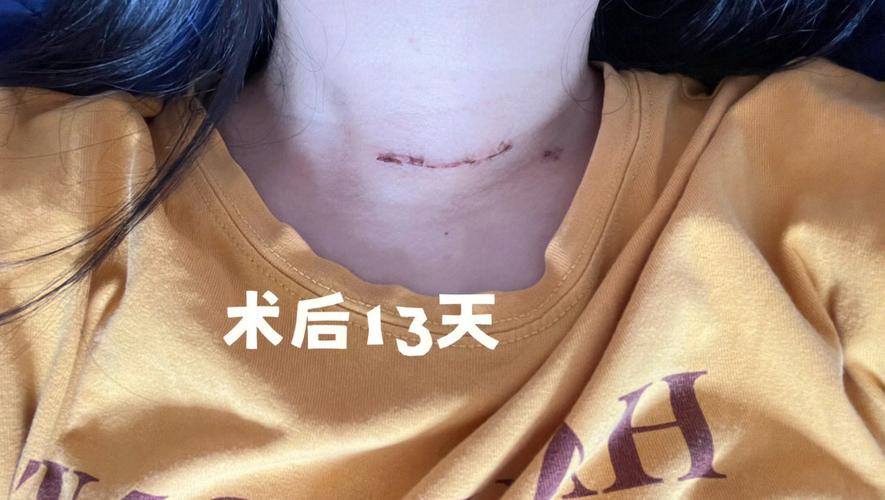 甲状腺癌半切不服药