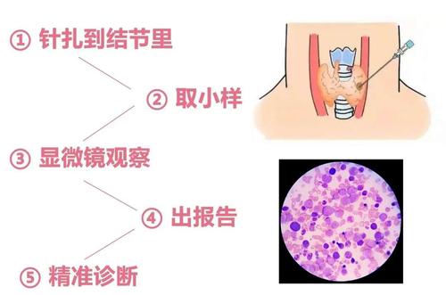 甲状腺癌粗针穿刺针