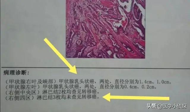 甲状腺癌带管状腺癌