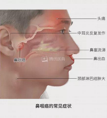 鼻咽癌化疗后会头痛吗