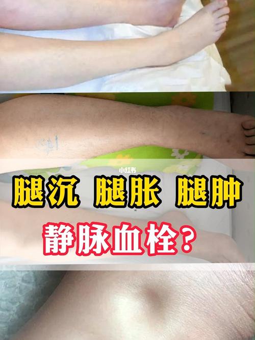 大腿静脉血栓形成严重吗？