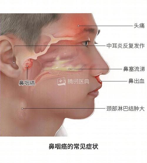 鼻咽癌会引起心悸吗 有什么症状