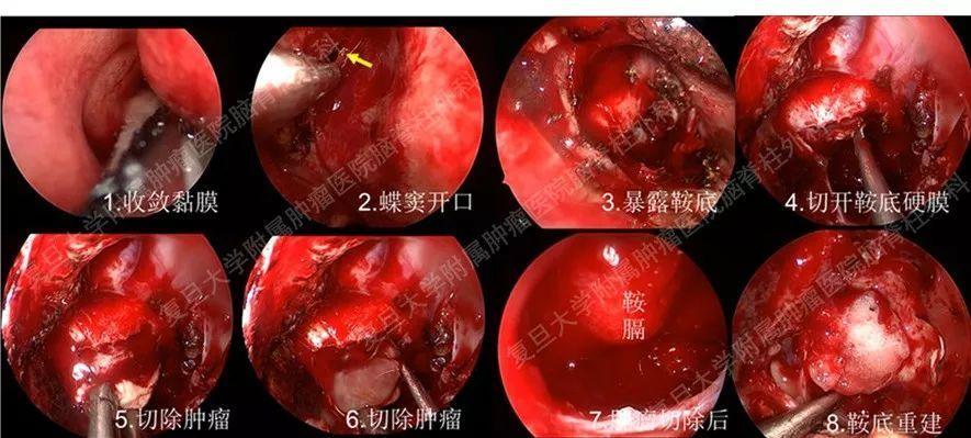 垂体瘤9MM需要手术吗？