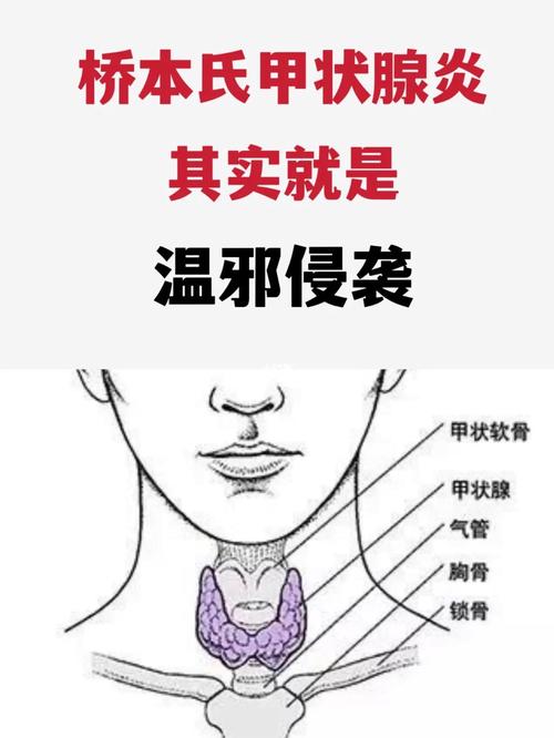 产后甲状腺炎有哪些典型症状