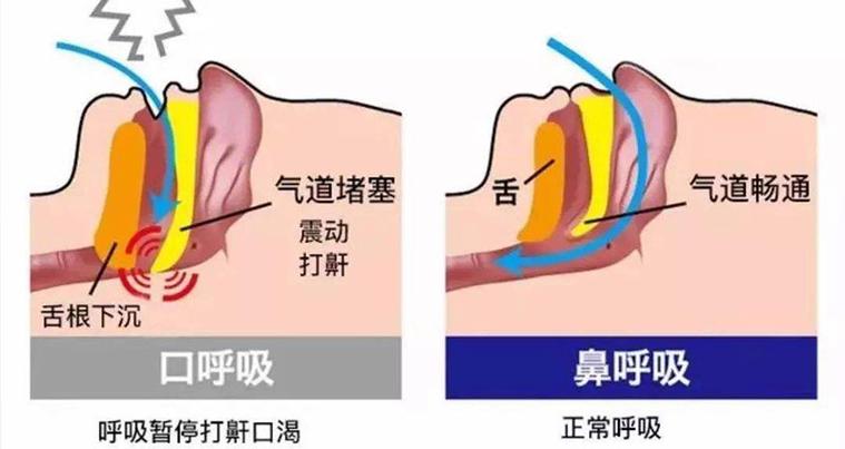 打鼾与心脏缺血有关吗？