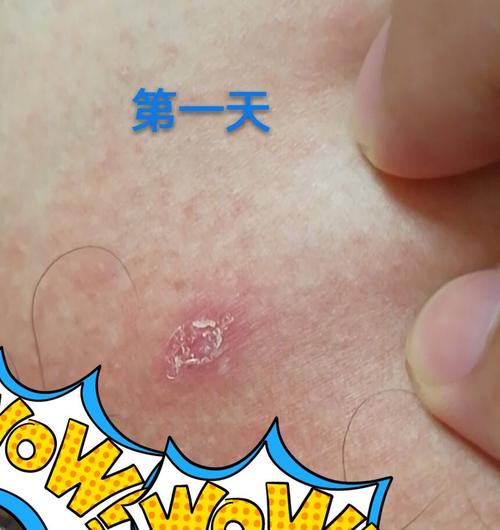 大腿内侧的痘痘是艾滋病吗？