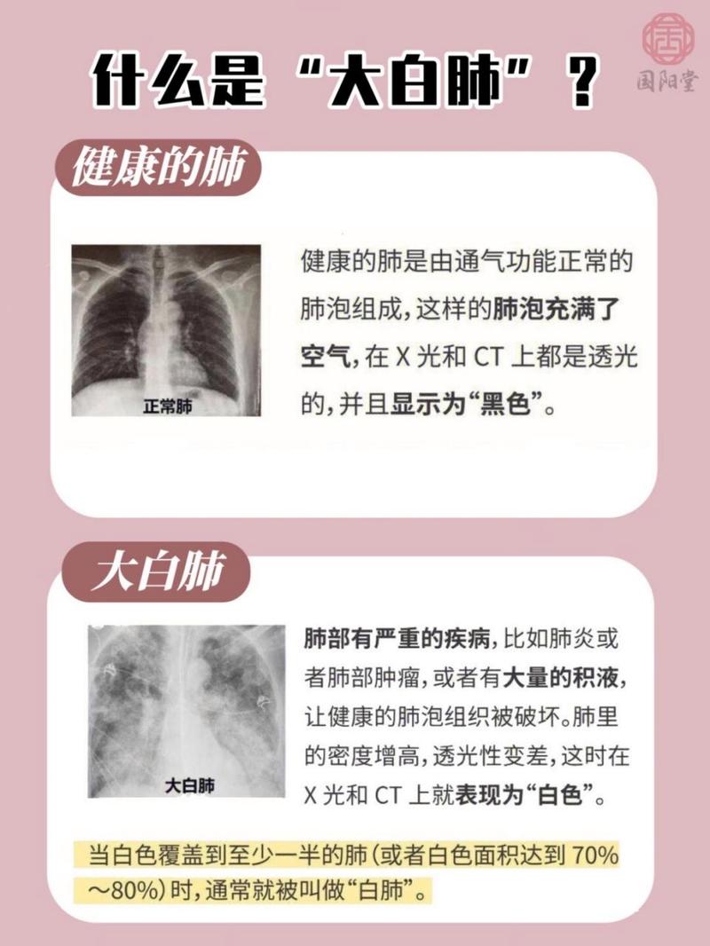 白血病能引起肺动脉高压吗？