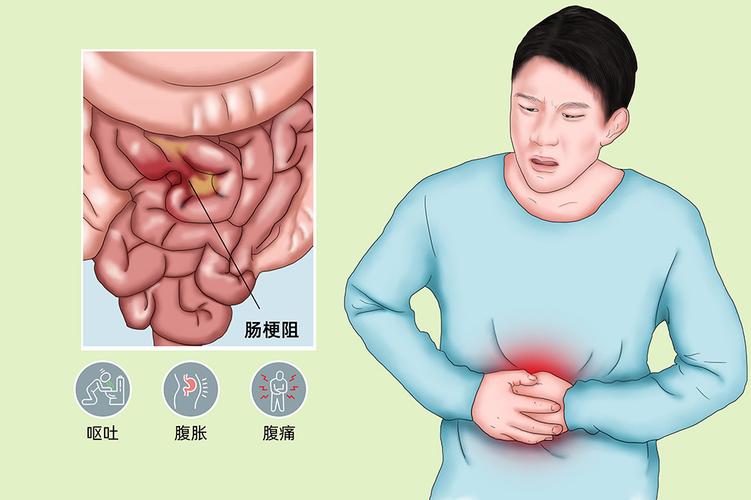 肠梗阻的症状是什么