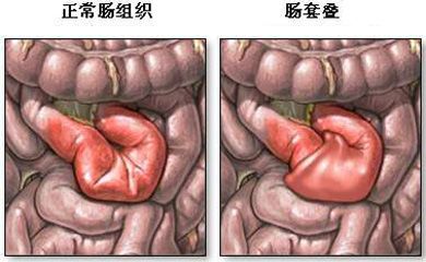 肠梗阻还会复发吗