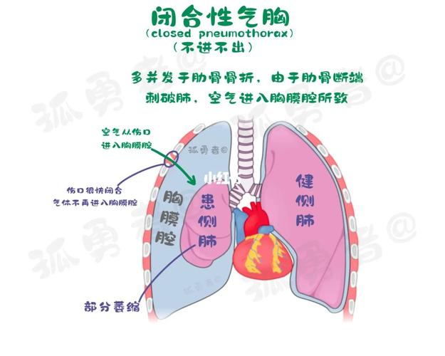 创伤性气胸应该如何预防