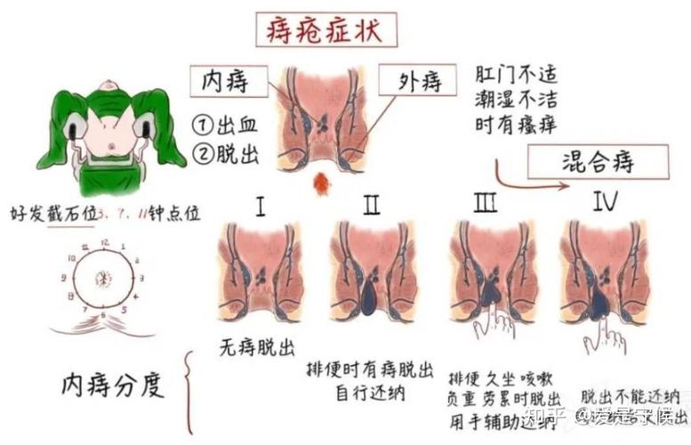 产后为什么会有痔疮