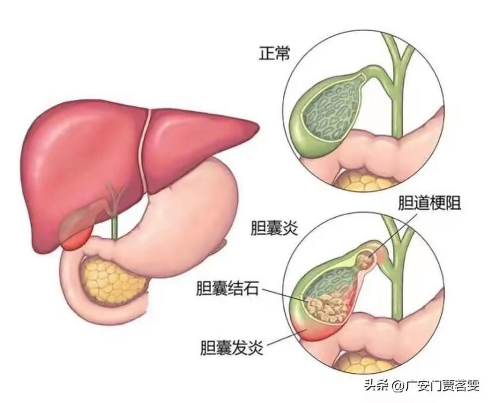 肠胃炎和胆结石哪个更严重