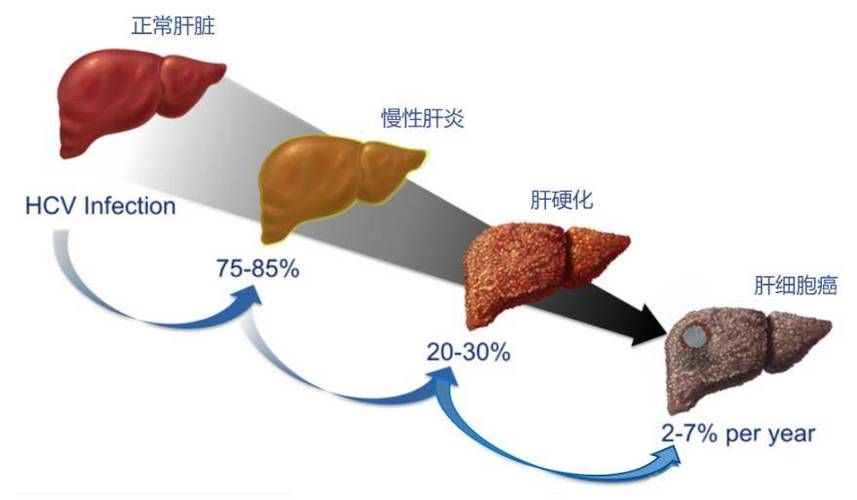 丙型肝炎的治疗方法有哪些