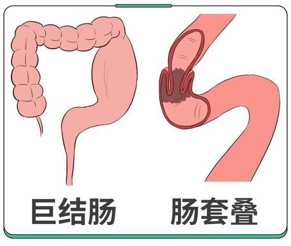 肠梗阻通过后吃了东西反而是黄水怎么了