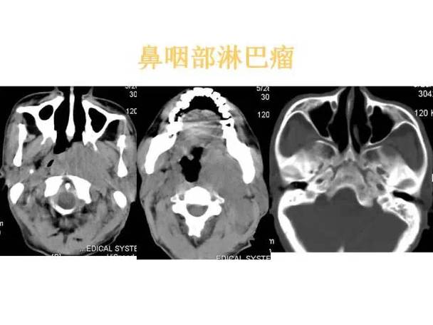 鼻咽淋巴瘤怎么治疗 要注意什么