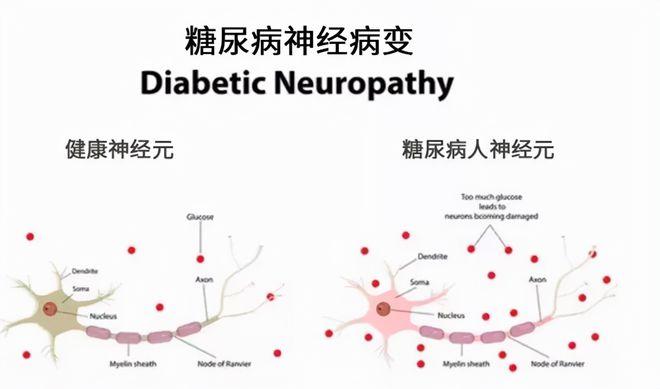 2型糖尿病周围神经病变