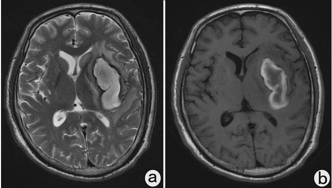 出血性脑梗死MR表现