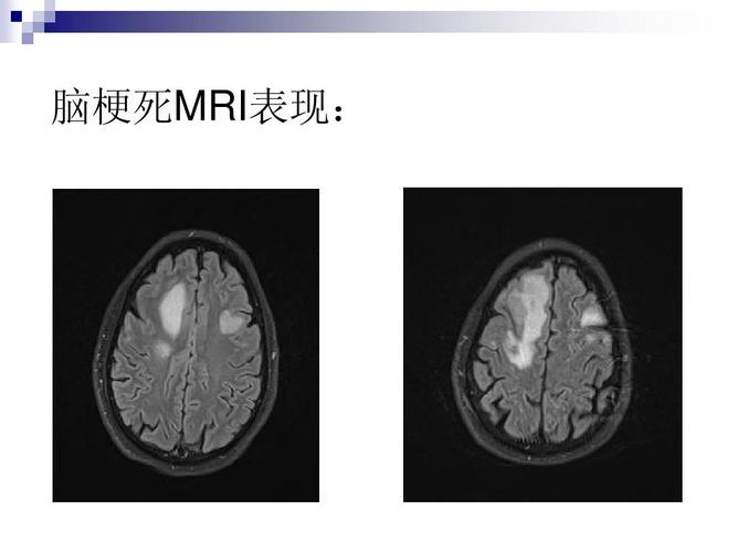 出血性脑梗死MR表现