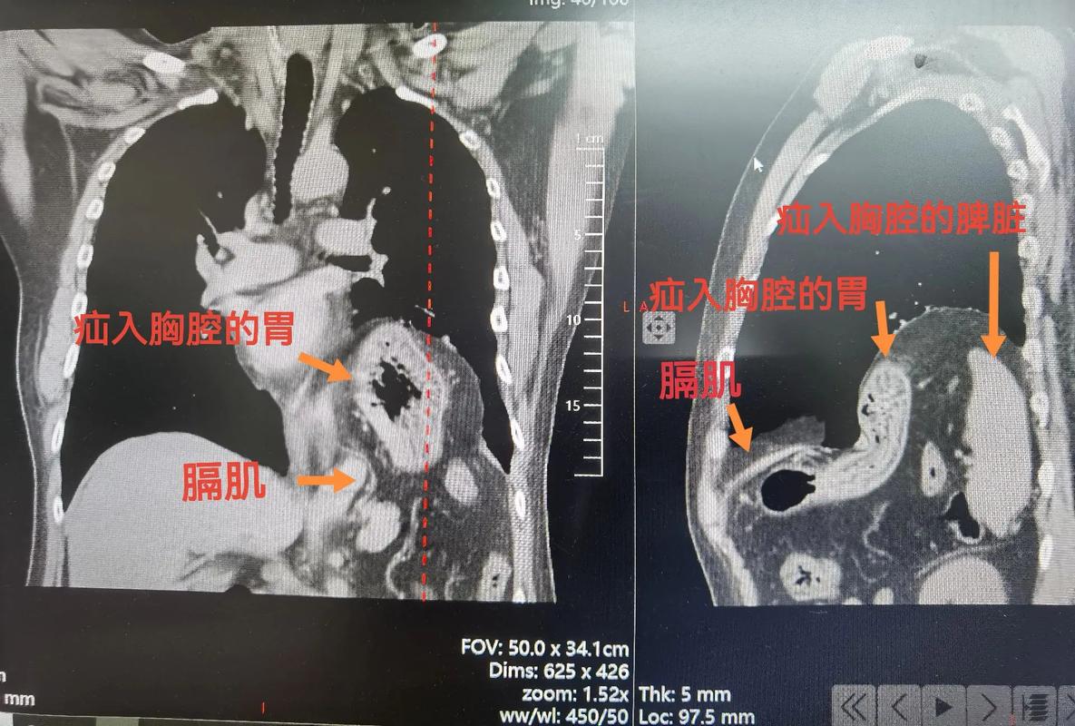 创伤性膈疝需要做哪些化验检查