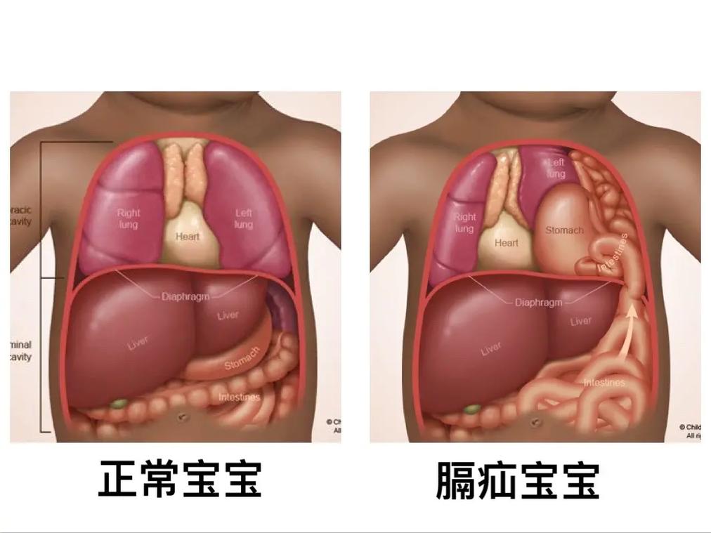 创伤性膈疝需要做哪些化验检查