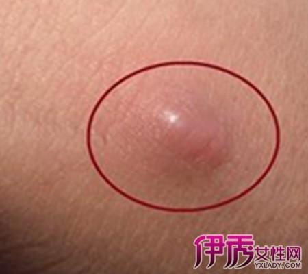 大腿淋巴瘤的早期症状有哪些 有什么食疗方法