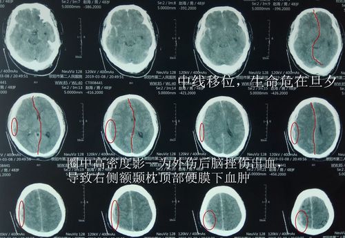 闭合性颅脑损伤会影响眼睛吗