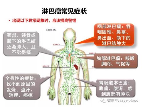 B型恶性淋巴瘤病因有哪些 恶性淋巴瘤是什么