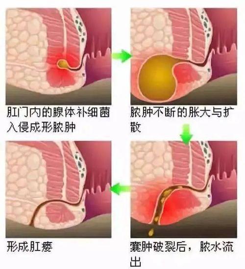 产后肛裂和痔疮的区别