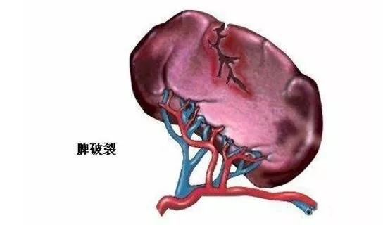 创伤性脾破裂有哪些典型症状