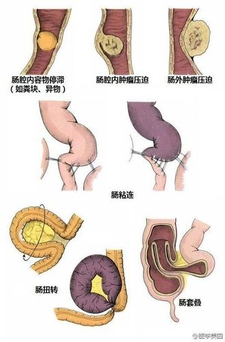 不完全性肠梗阻严重吗