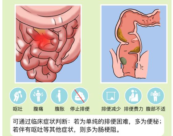 肠梗阻的最佳治疗方法