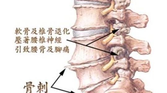 骨质增生包括软骨增生吗