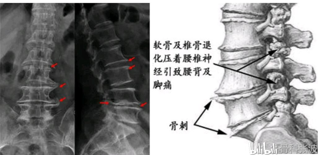 骨质增生x片怎么看出来