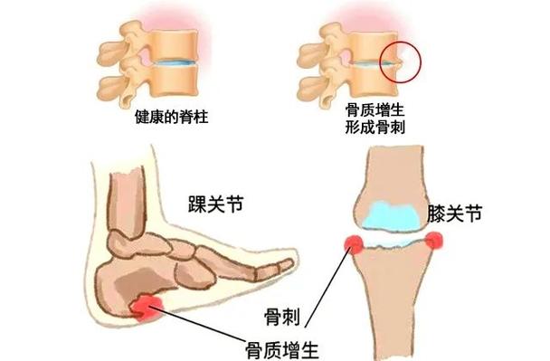 骨关节治关节骨质增生吗