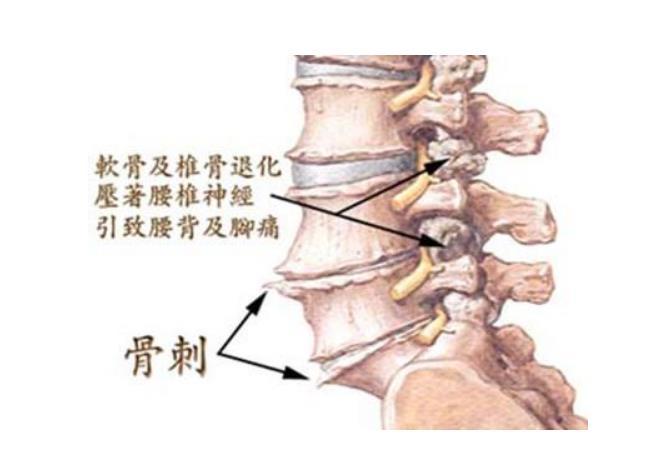 骨质增生变尖需要手术吗