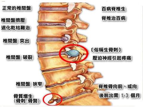 骨质增生变尖需要手术吗