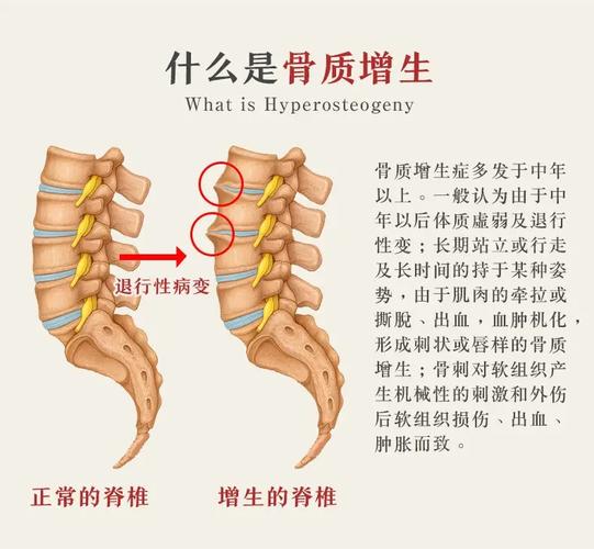 骨质增生病因是什么意思