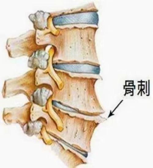 骨质增生病发原因是什么